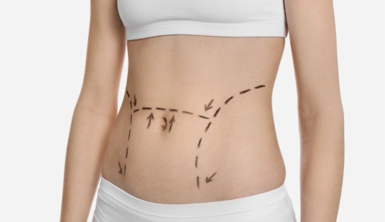 Belly-operation-recovery