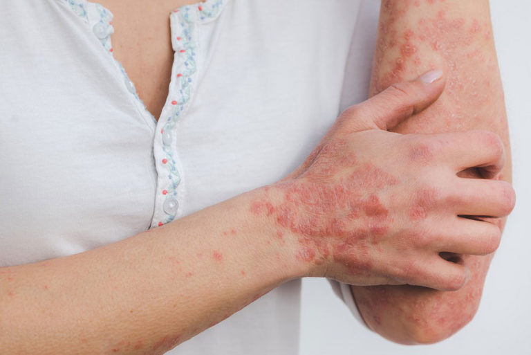 6 Things That You Should Do To Prevent Any Inflammation On Your Skin