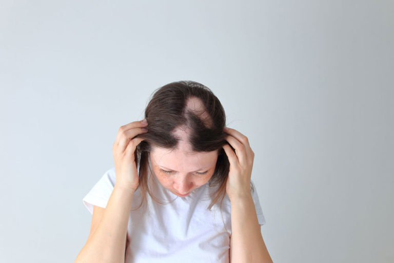 4 Tips For A successful FUE Hair Transplant