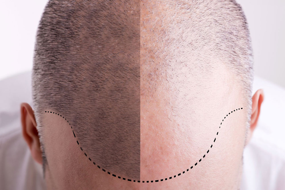 hair-transplant-tips