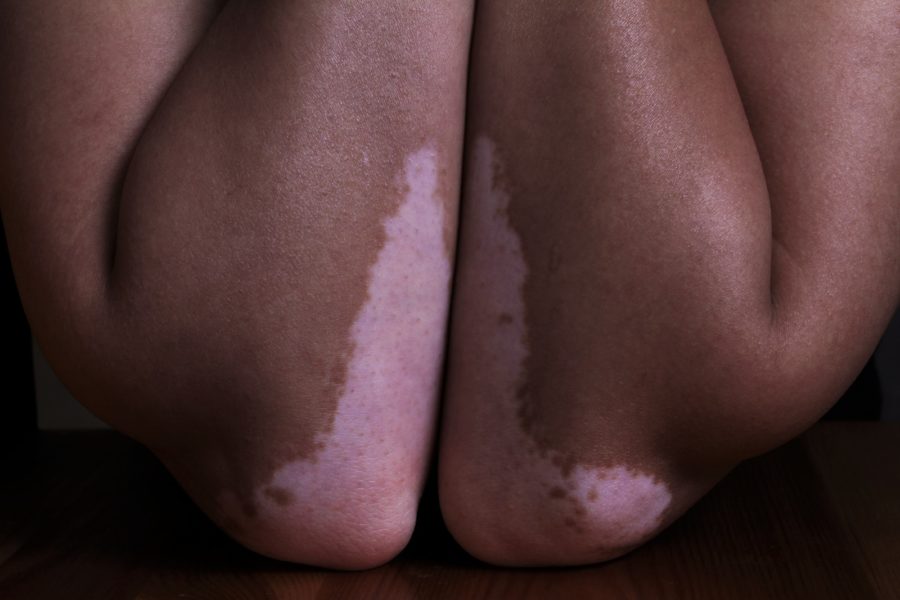 Vitiligo-skin-problems